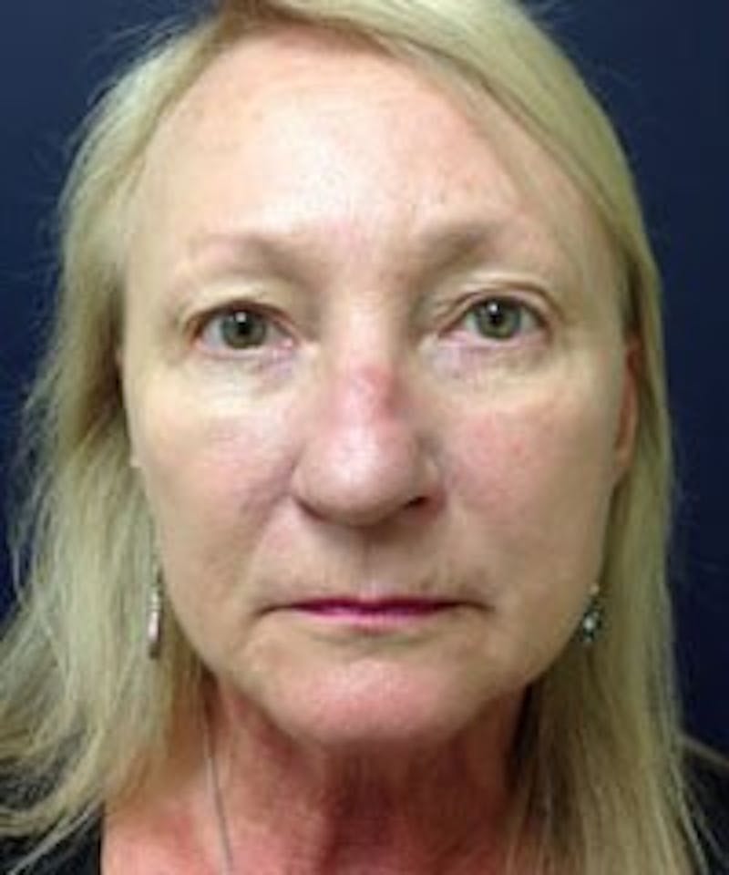 BBL™ Laser Before & After Gallery - Patient 90436670 - Image 2