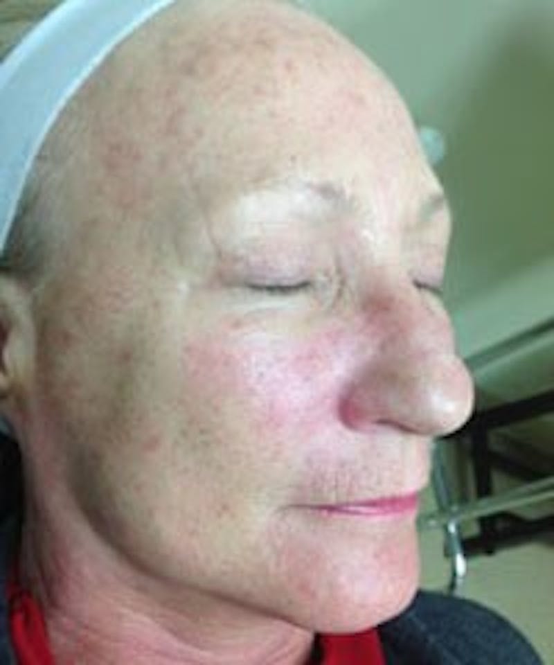 BBL™ Laser Before & After Gallery - Patient 90436670 - Image 3