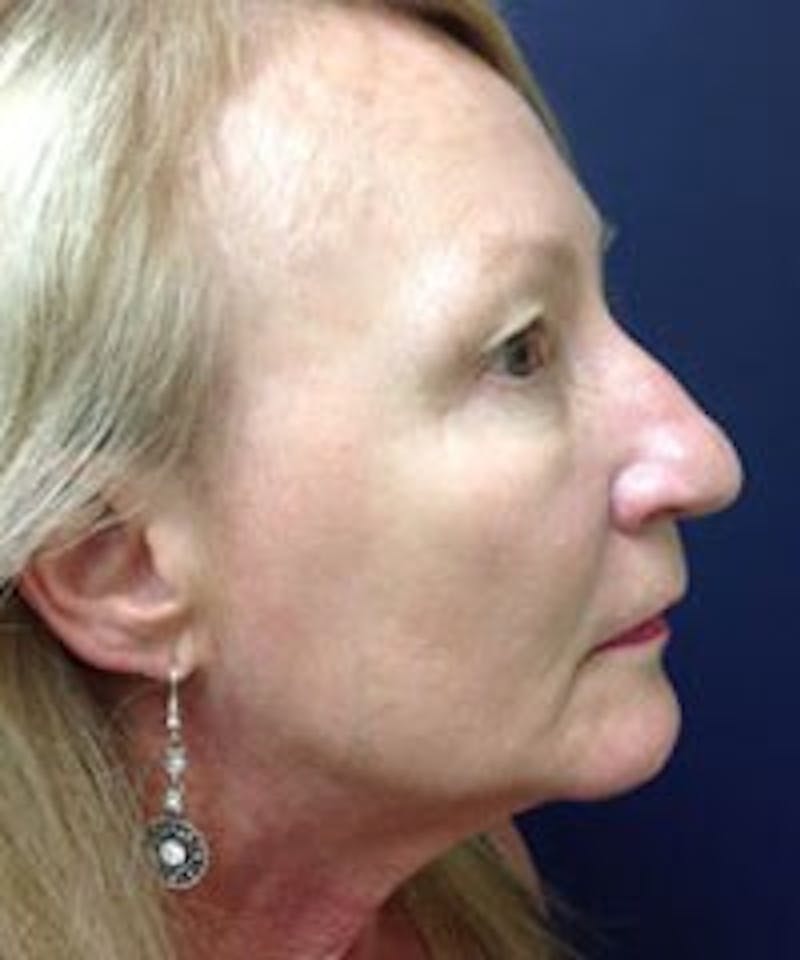 BBL™ Laser Before & After Gallery - Patient 90436670 - Image 4