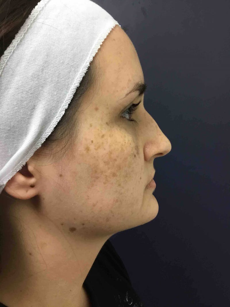 BBL™ Laser Before & After Gallery - Patient 90436689 - Image 3