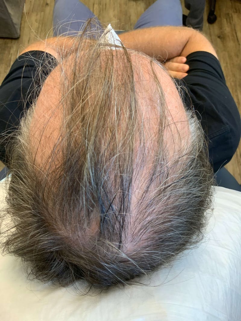 PRP Hair Restoration Before & After Gallery - Patient 90436806 - Image 1