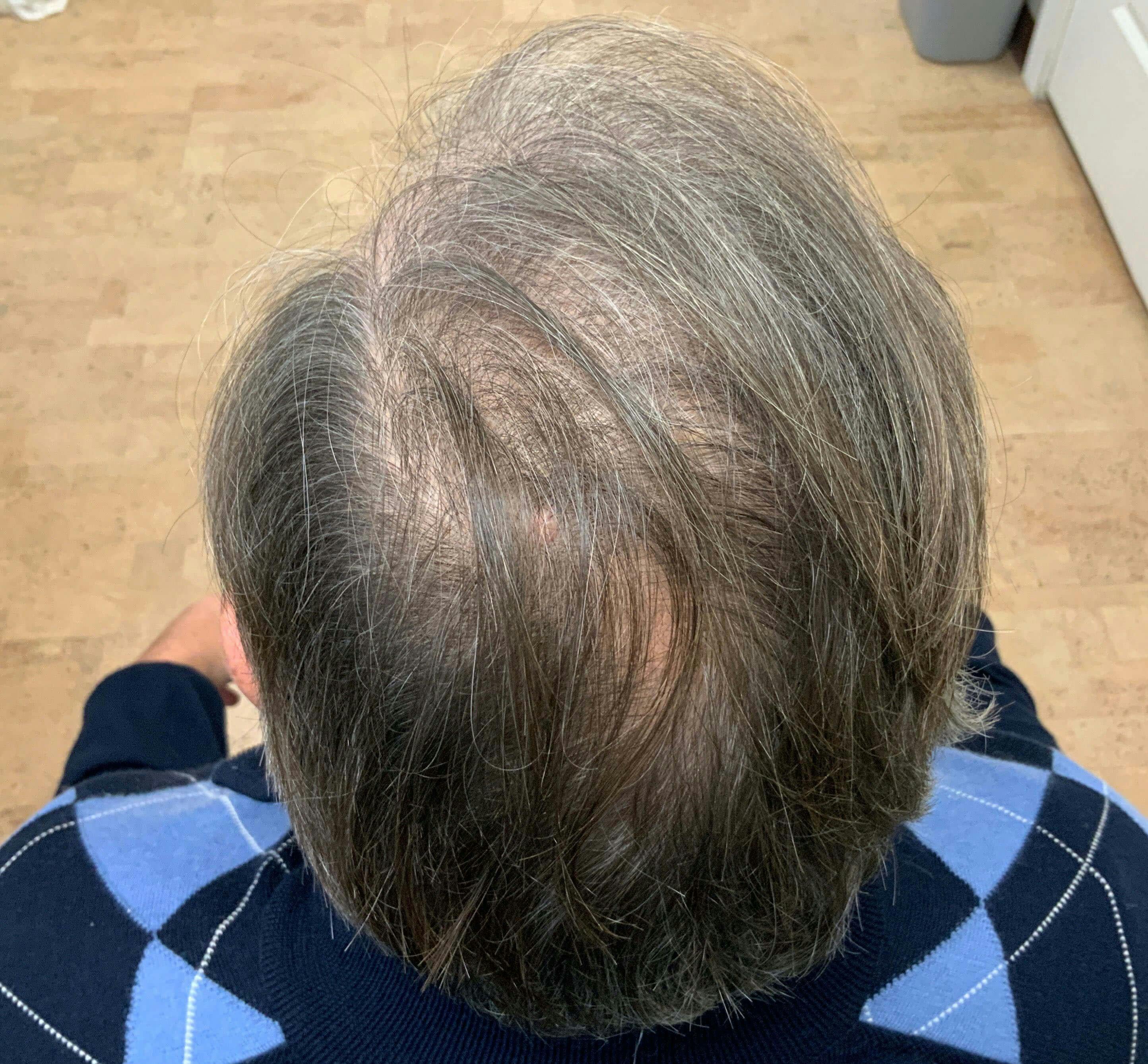 PRP Hair Restoration