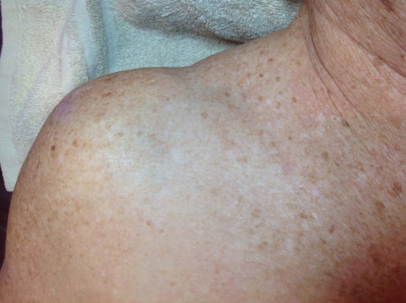 Cryotherapy Before & After Gallery - Patient 90452067 - Image 4