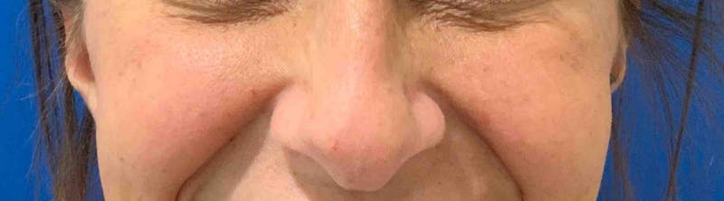 Cryotherapy Before & After Gallery - Patient 90452071 - Image 2