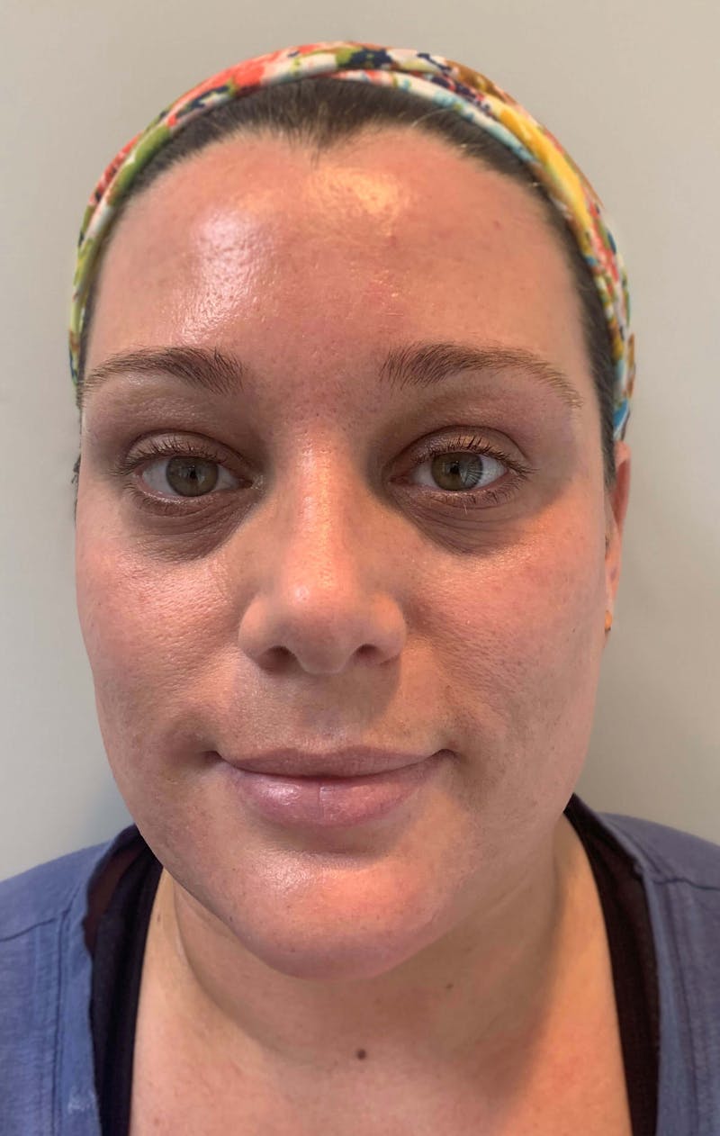 Microneedling Before & After Gallery - Patient 90452110 - Image 2