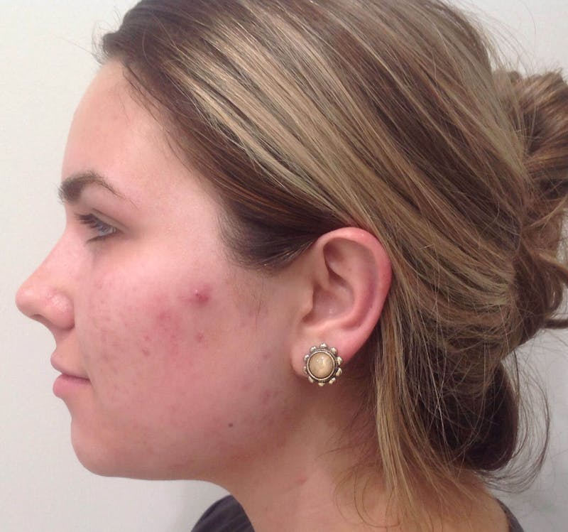 Microneedling Before & After Gallery - Patient 90452114 - Image 3