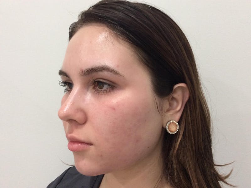 Microneedling Before & After Gallery - Patient 90452114 - Image 4