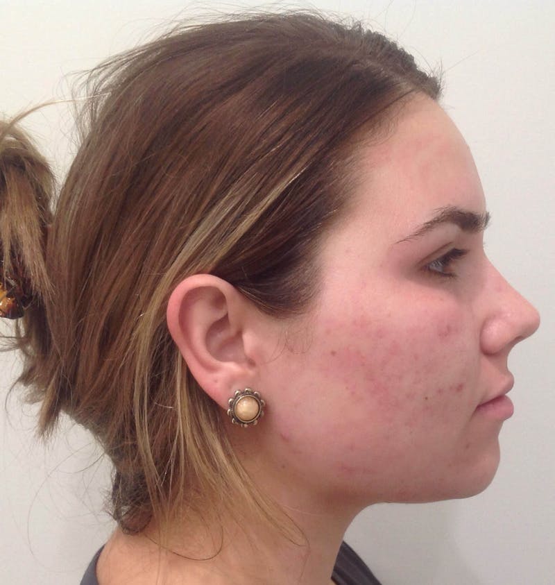 Microneedling Before & After Gallery - Patient 90452114 - Image 5