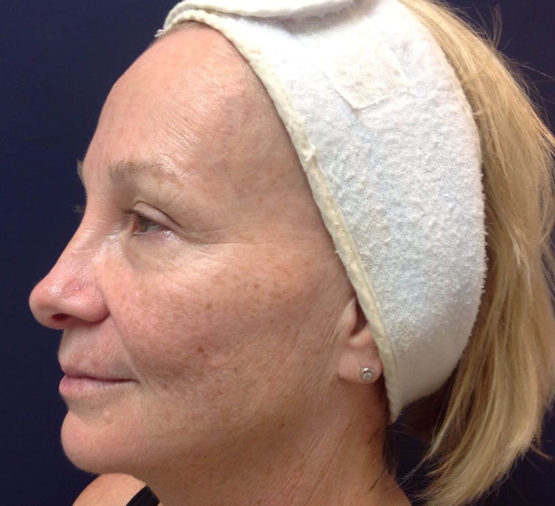 Microneedling Before & After Gallery - Patient 90452115 - Image 1