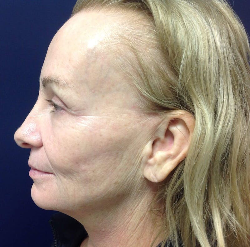 Microneedling Before & After Gallery - Patient 90452115 - Image 2
