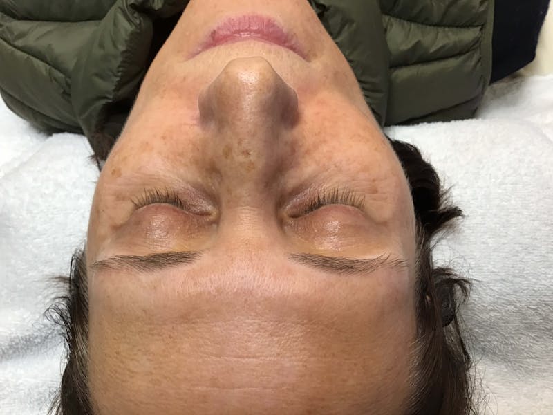 HydraFacial® Before & After Gallery - Patient 90456726 - Image 1