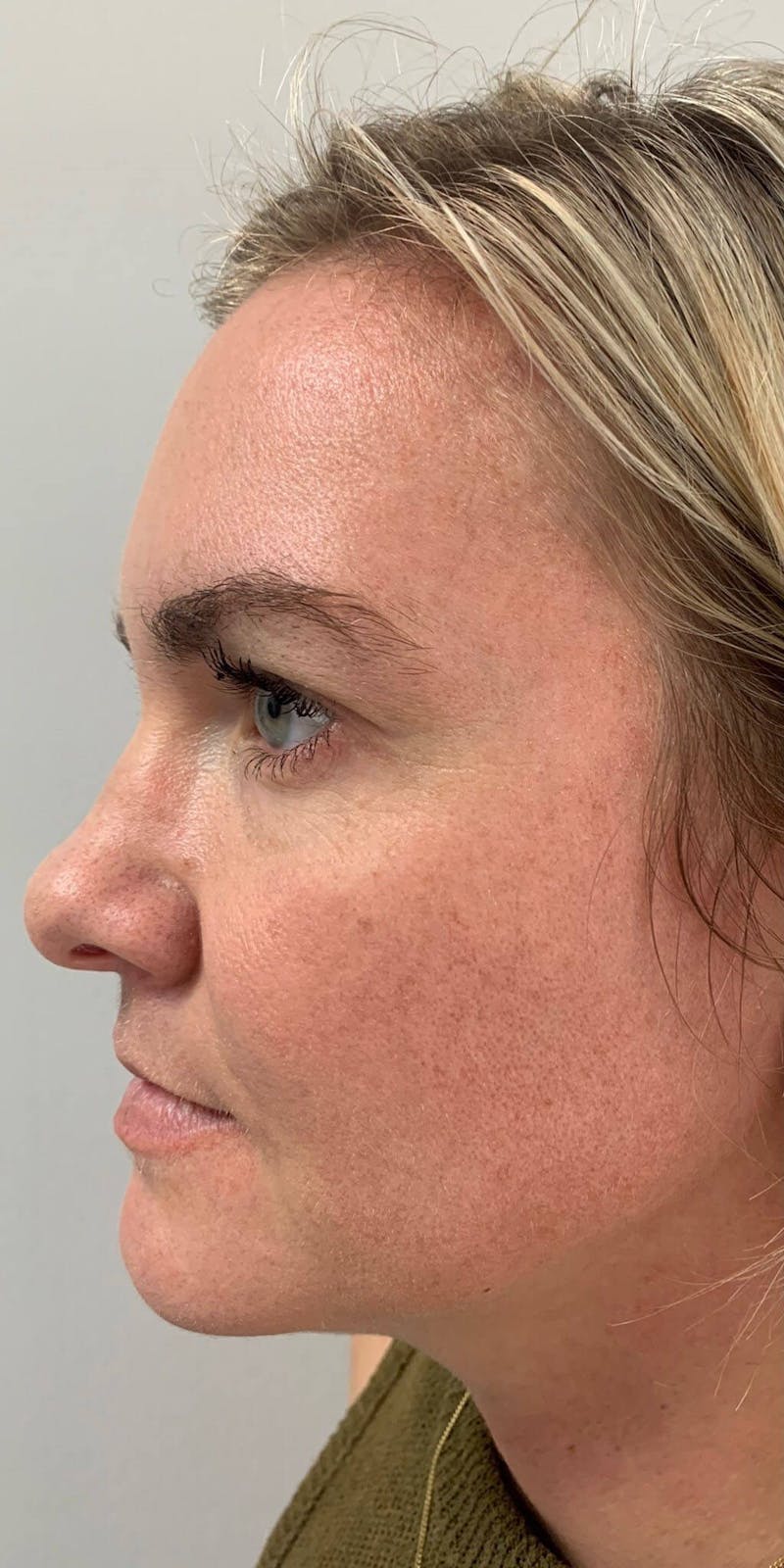 HydraFacial® Before & After Gallery - Patient 90456749 - Image 1