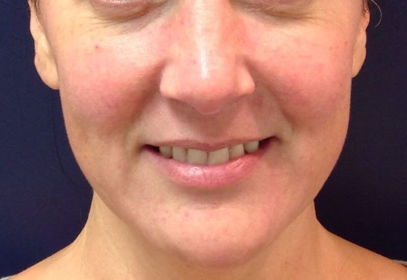 Clear + Brilliant Before & After Gallery - Patient 90456770 - Image 1