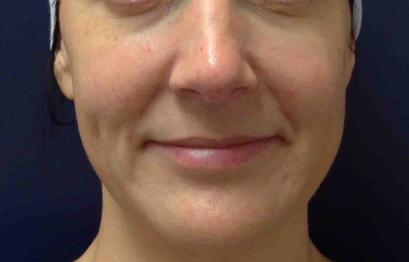 Clear + Brilliant Before & After Gallery - Patient 90456770 - Image 2
