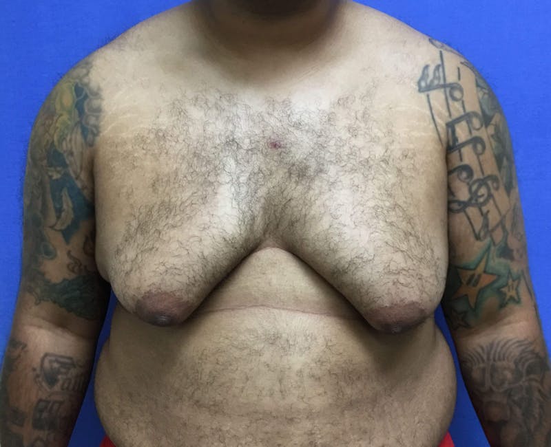 Gynecomastia  Before & After Gallery - Patient 90456853 - Image 1