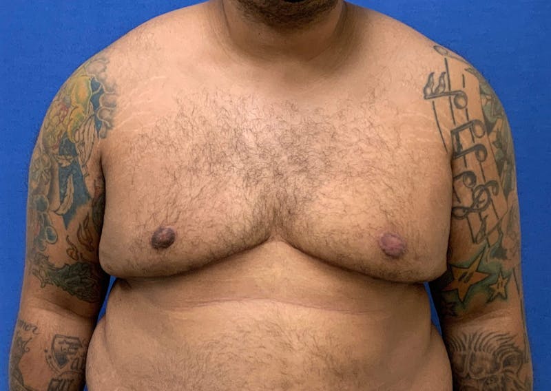 Gynecomastia  Before & After Gallery - Patient 90456853 - Image 2