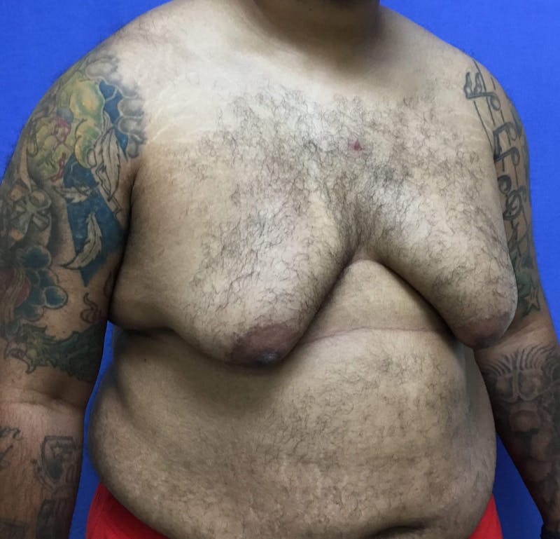 Gynecomastia  Before & After Gallery - Patient 90456853 - Image 5
