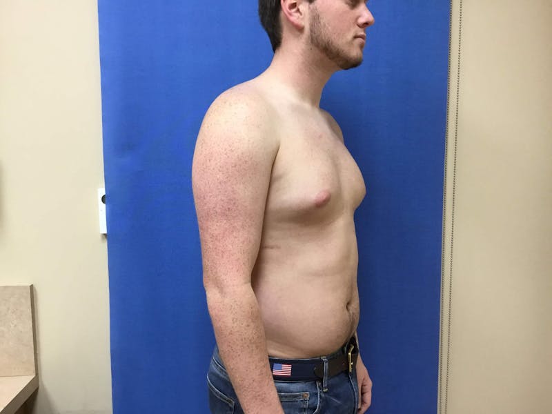 Gynecomastia  Before & After Gallery - Patient 90456856 - Image 1