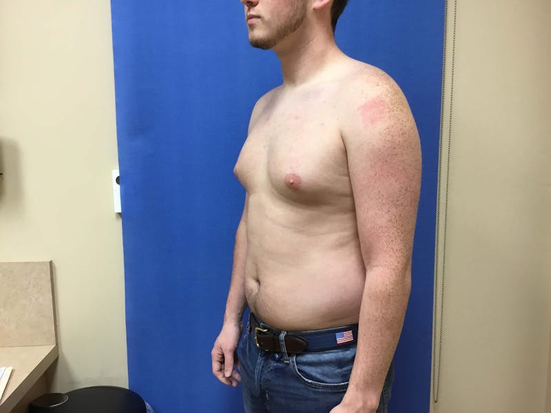 Gynecomastia  Before & After Gallery - Patient 90456856 - Image 3