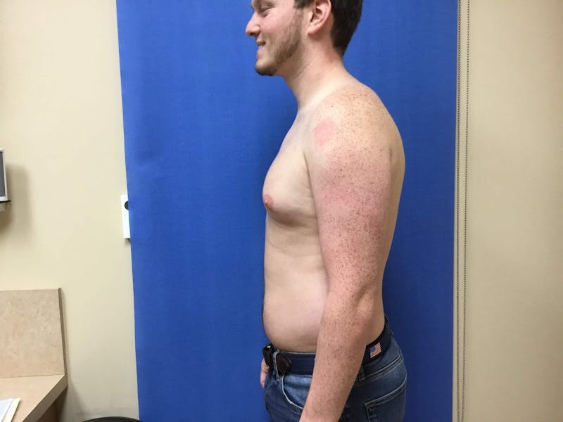 Gynecomastia  Before & After Gallery - Patient 90456856 - Image 5