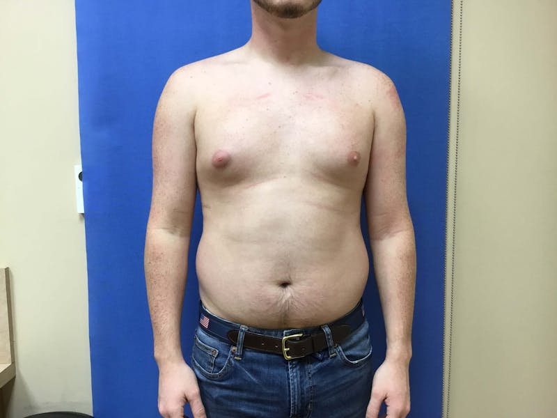 Gynecomastia  Before & After Gallery - Patient 90456856 - Image 9