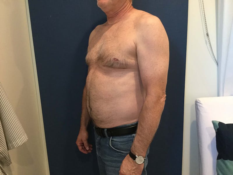 Gynecomastia  Before & After Gallery - Patient 90456859 - Image 4