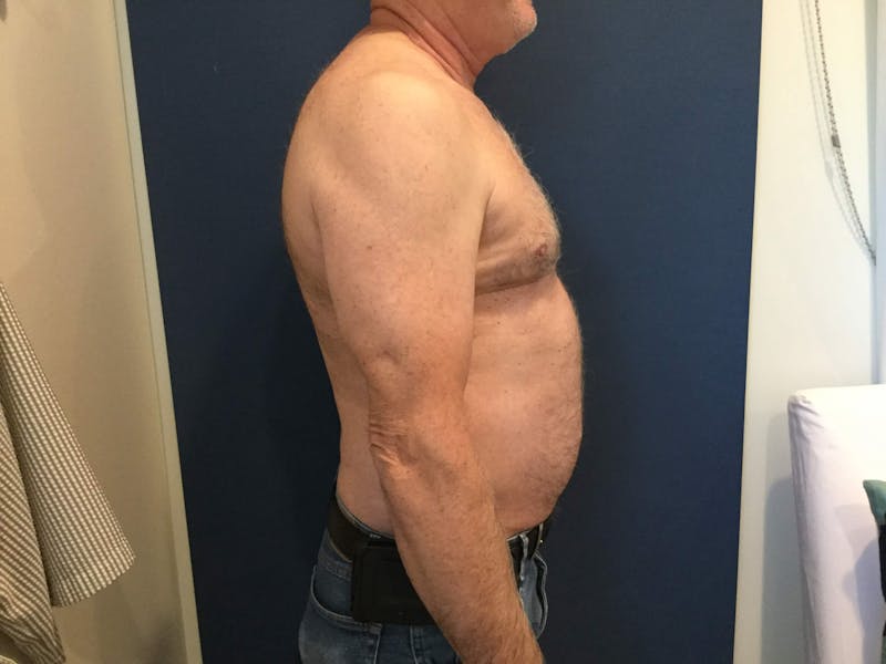 Gynecomastia  Before & After Gallery - Patient 90456859 - Image 6