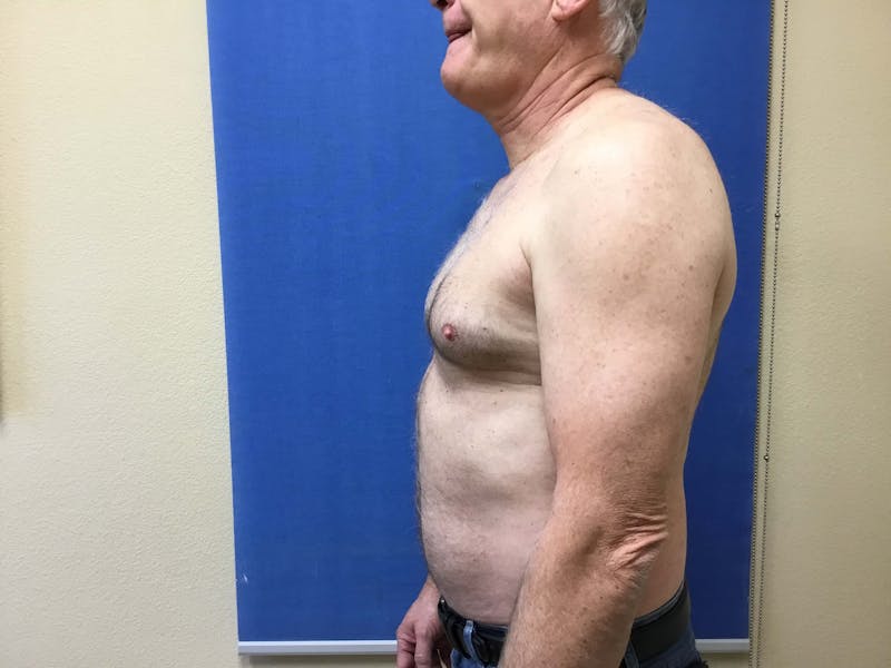 Gynecomastia  Before & After Gallery - Patient 90456859 - Image 7