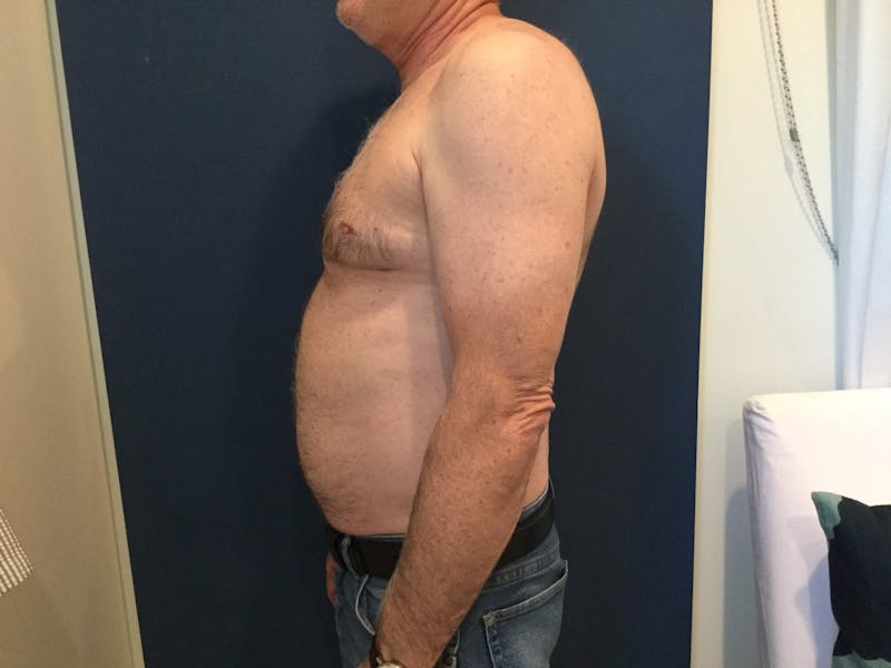 Gynecomastia  Before & After Gallery - Patient 90456859 - Image 8