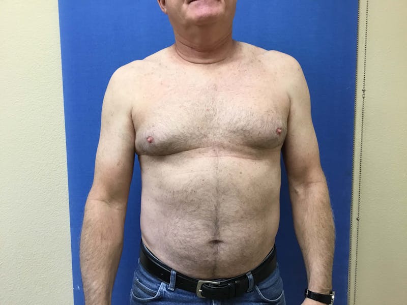 Gynecomastia  Before & After Gallery - Patient 90456859 - Image 9