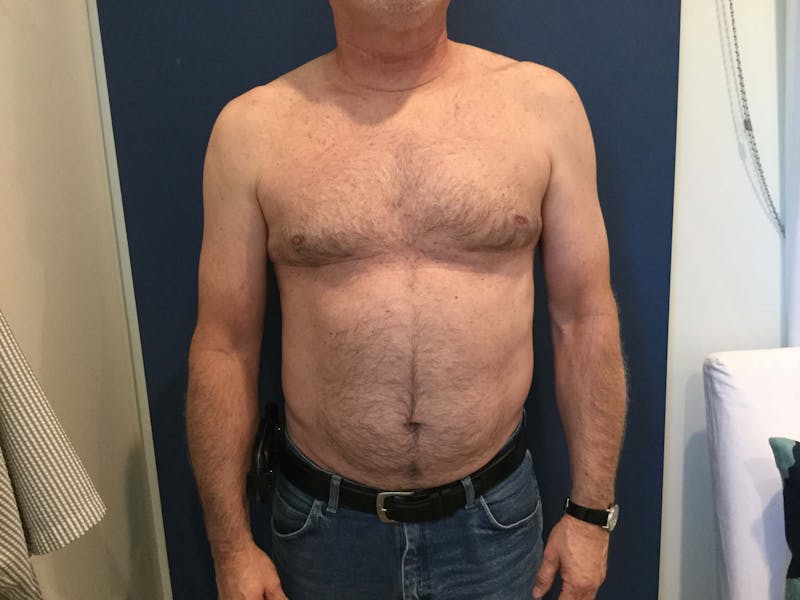 Gynecomastia  Before & After Gallery - Patient 90456859 - Image 10