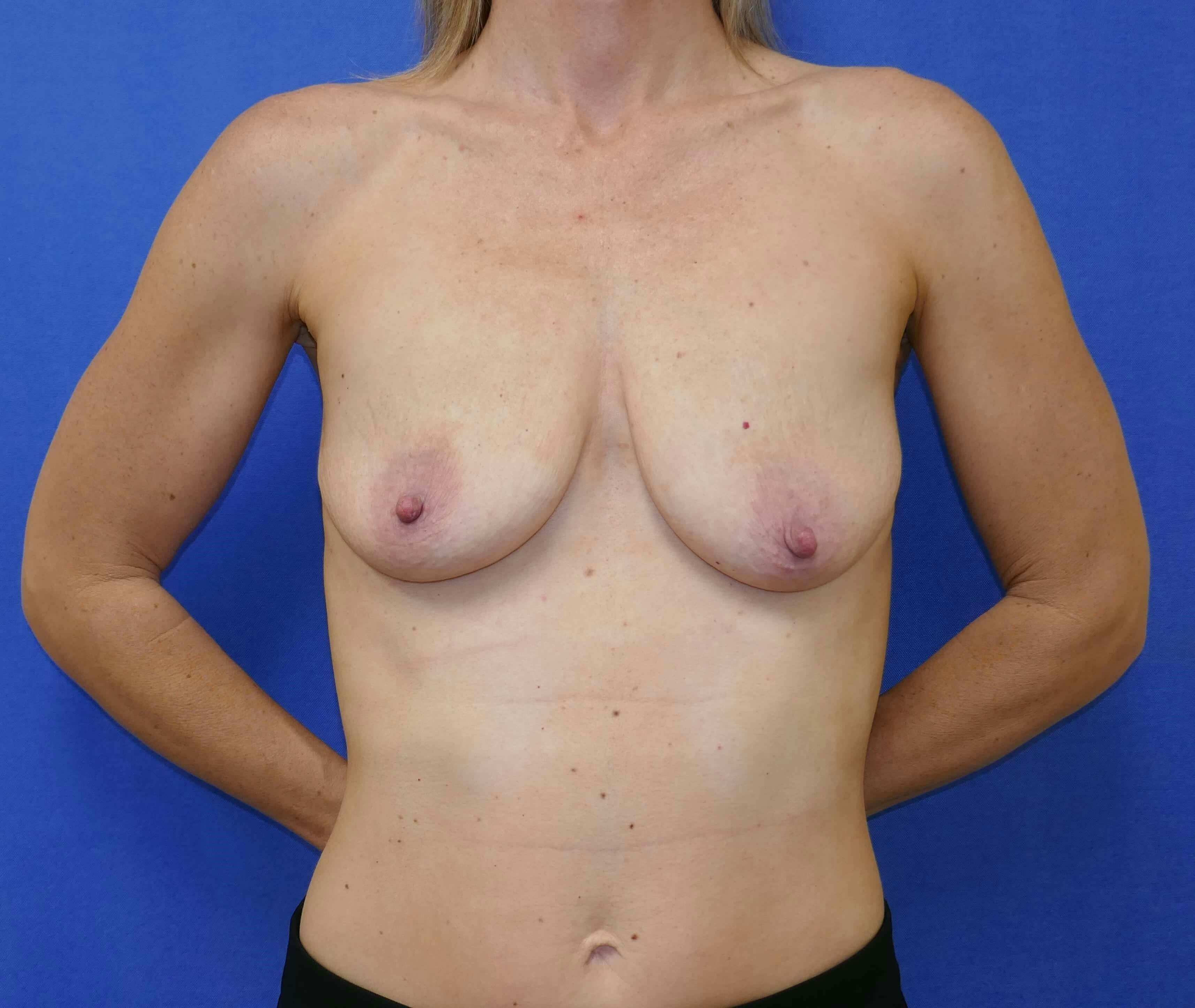 Breat Augmentation With Lift Gallery - Patient 90456867 - Image 1