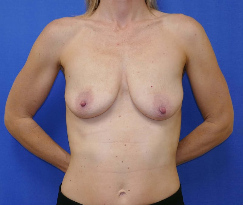 Breat Augmentation With Lift Before & After Gallery - Patient 90456867 - Image 1