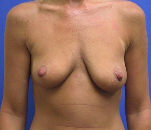 Breat Augmentation With Lift Gallery - Patient 90456872 - Image 1