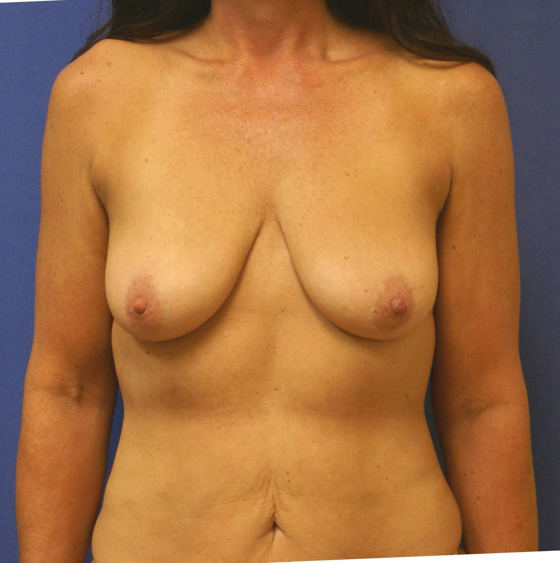 Breat Augmentation With Lift Gallery - Patient 90456873 - Image 1