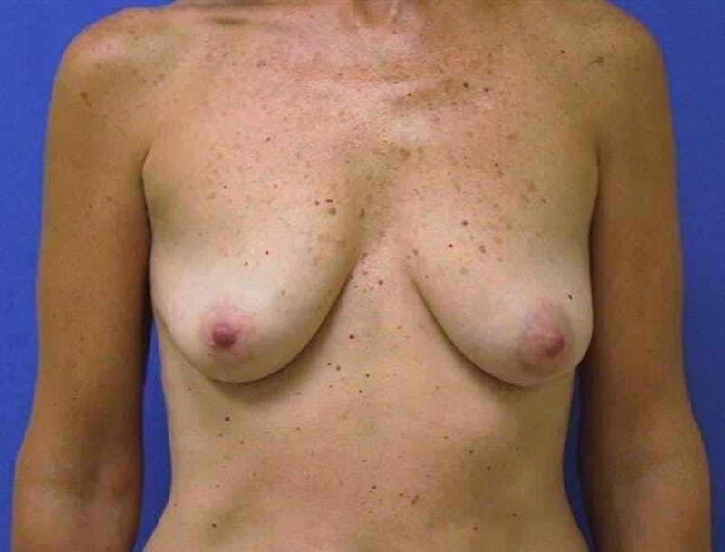 Breat Augmentation With Lift Before & After Gallery - Patient 90456875 - Image 1