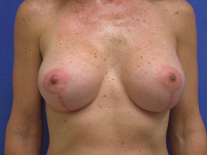 Breat Augmentation With Lift Before & After Gallery - Patient 90456875 - Image 2