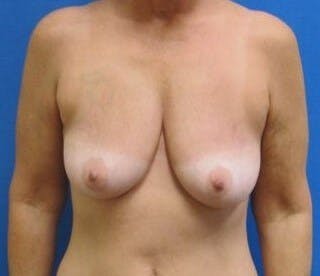 Breat Augmentation With Lift Gallery - Patient 90456877 - Image 1