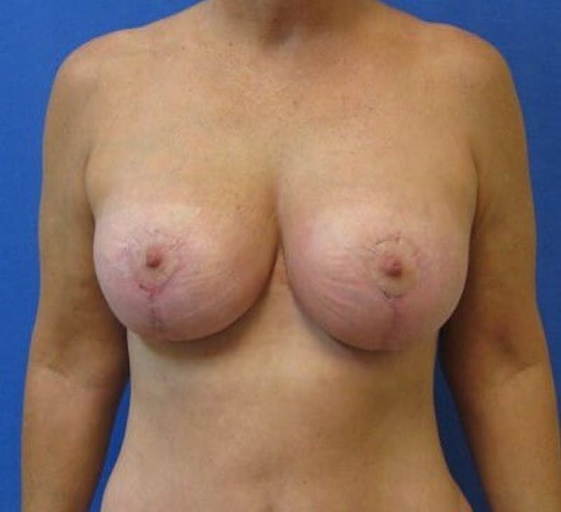 Breat Augmentation With Lift Before & After Gallery - Patient 90456877 - Image 2