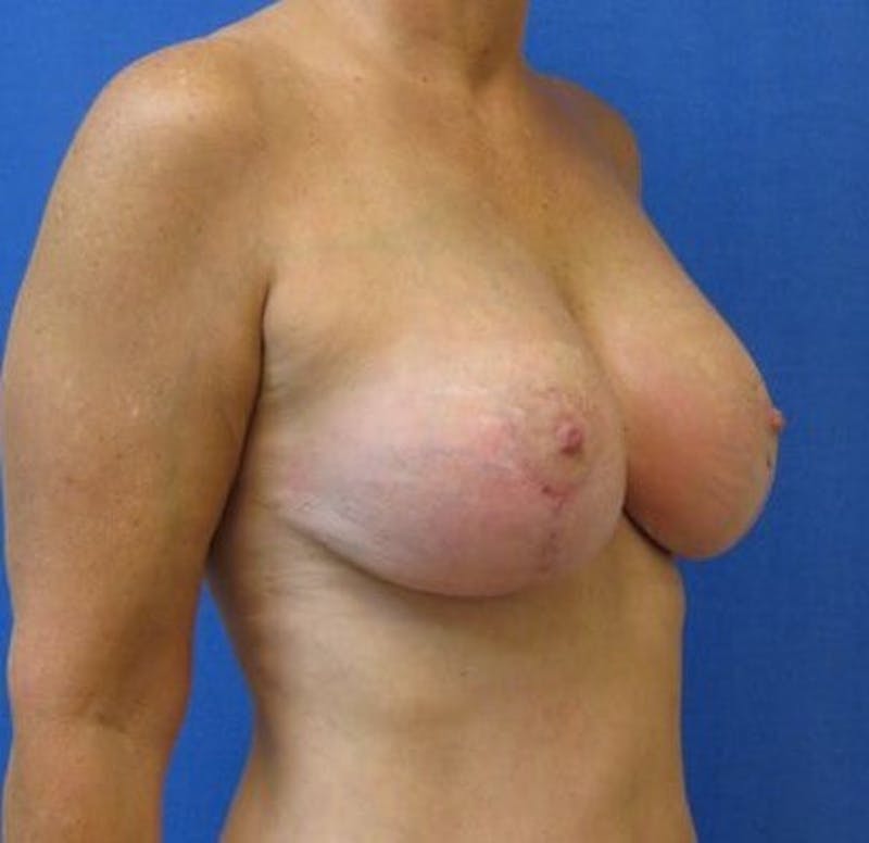 Breat Augmentation With Lift Before & After Gallery - Patient 90456877 - Image 4