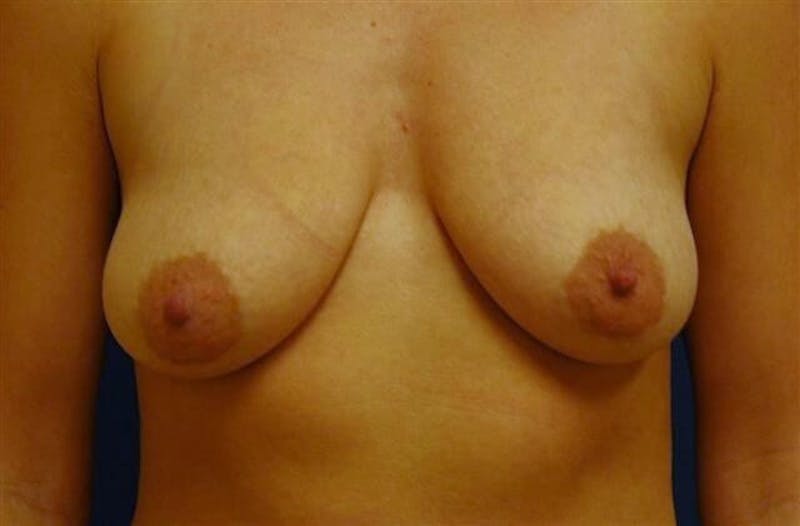 Breat Augmentation With Lift Before & After Gallery - Patient 90456881 - Image 1