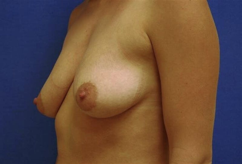 Breat Augmentation With Lift Before & After Gallery - Patient 90456881 - Image 3