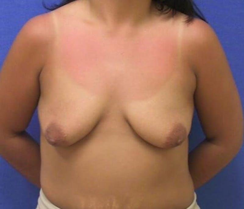Breat Augmentation With Lift Before & After Gallery - Patient 90456896 - Image 1