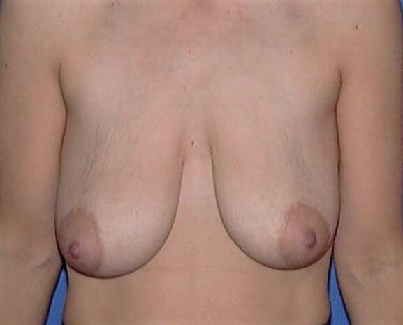 Breat Augmentation With Lift Gallery - Patient 90456898 - Image 1