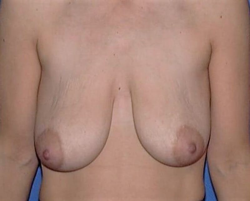 Breat Augmentation With Lift Before & After Gallery - Patient 90456898 - Image 1
