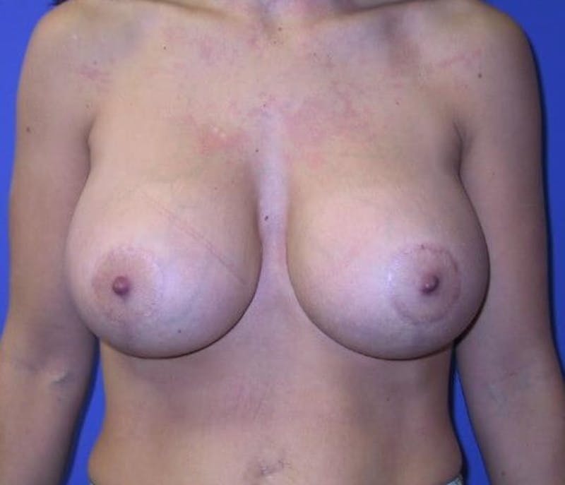 Breat Augmentation With Lift Before & After Gallery - Patient 90456898 - Image 2