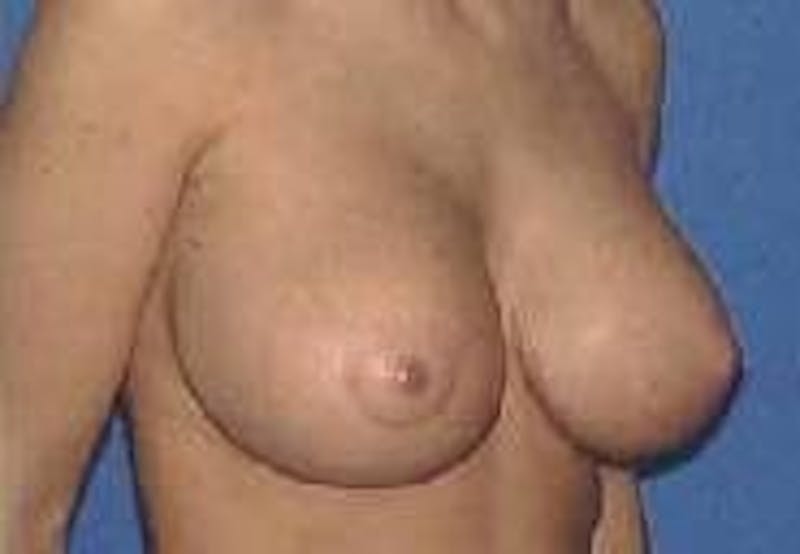 Breat Augmentation With Lift Before & After Gallery - Patient 90456898 - Image 6