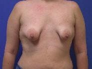 Breat Augmentation With Lift Gallery - Patient 90456901 - Image 1