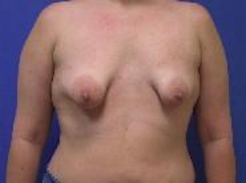 Breat Augmentation With Lift Before & After Gallery - Patient 90456901 - Image 1