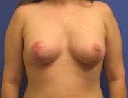 Breat Augmentation With Lift Gallery - Patient 90456901 - Image 2